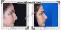 عمل بینی شماره 427غضروفی با پوست ضخیم