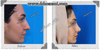 عمل بینی شماره 440غضروفی با پوست ضخیم