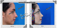 عمل بینی شماره 442غضروفی (استخوانی)