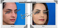 عمل بینی شماره 443غضروفی (استخوانی)