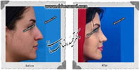  جراحی بینی -446