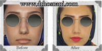  جراحی بینی -45