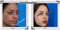  جراحی بینی -450