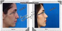  جراحی بینی -452