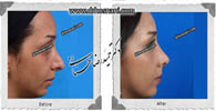  جراحی بینی -460