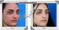  جراحی بینی -466