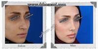  جراحی بینی -47