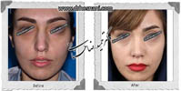 عمل بینی شماره 499
