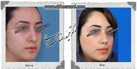 عمل بینی شماره 506