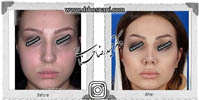 عمل بینی شماره 513