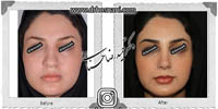 عمل بینی شماره 517