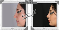 عمل بینی شماره 518