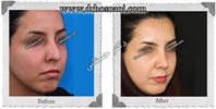 عمل بینی شماره 520