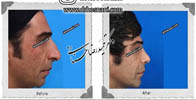  جراحی بینی -524