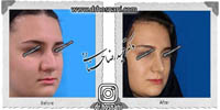 عمل بینی شماره 555