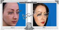 عمل بینی شماره 557