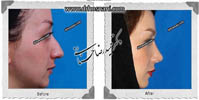 عمل بینی شماره 558
