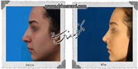  جراحی بینی -595