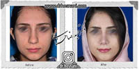 عمل بینی شماره 597غضروفی با پوست ضخیم