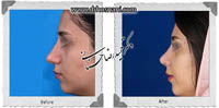  جراحی بینی -598