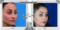 عمل بینی شماره 611