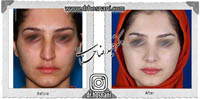 عمل بینی شماره 613غضروفی (استخوانی)