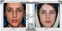 عمل بینی شماره 615