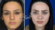 عمل بینی شماره 617