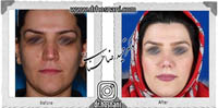 عمل بینی شماره 620