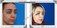 عمل بینی شماره 631