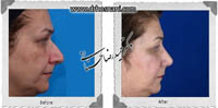 عمل بینی شماره 662