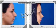  جراحی بینی -681