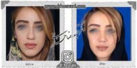 عمل بینی شماره 686غضروفی با پوست ضخیم