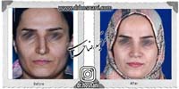عمل بینی شماره 688