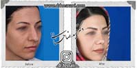 عمل بینی شماره 690