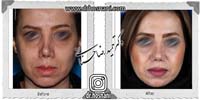 عمل بینی شماره 692