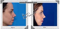 عمل بینی شماره 693