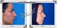  جراحی بینی -694