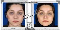 عمل بینی شماره 700گوشتی