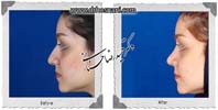 عمل بینی شماره 701گوشتی