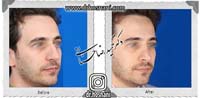 عمل بینی شماره 704