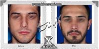  جراحی بینی -710