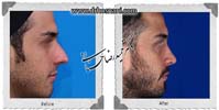 جراحی بینی -711