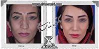  جراحی بینی -714