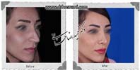  جراحی بینی -715