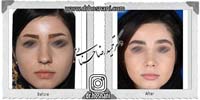 عمل بینی شماره 716غضروفی با پوست ضخیم