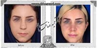 عمل بینی شماره 718