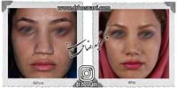 عمل بینی شماره 720