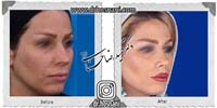 عمل بینی شماره 722