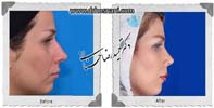 عمل بینی شماره 723